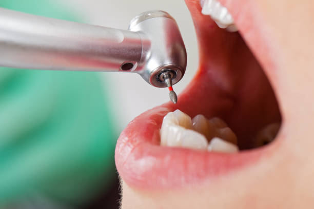 Best Emergency Tooth Extraction in Goliad, TX